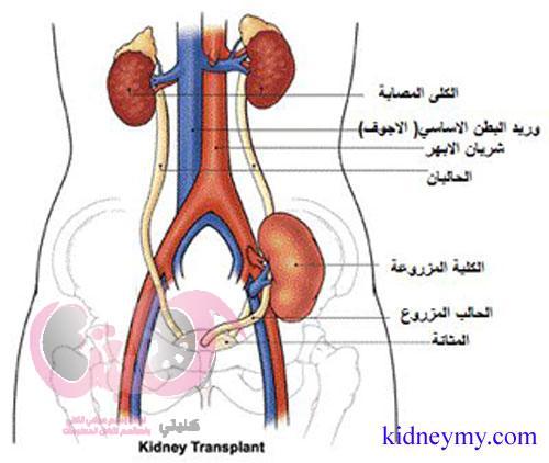نصائح بعد زراعة الكلى وافضل 17 نصيحة مجربة لمرضي زراعة الكلي