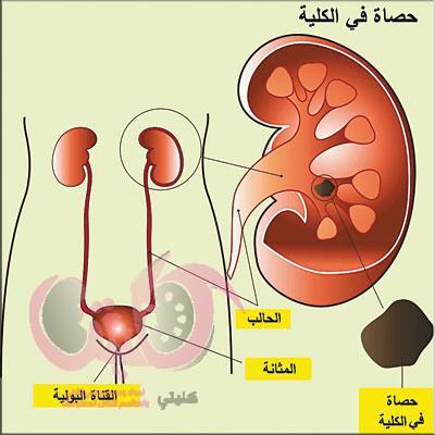 اطعمة تساعد علي تفتيت ومنع تكوين حصوات الكلي