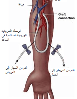 الوصلة الوريدية الشريانية لمرضى غسيل الكلى