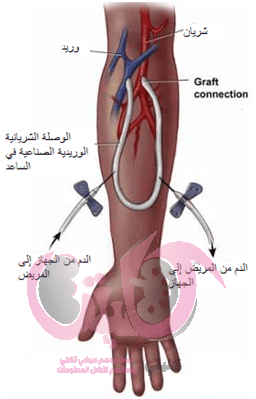 الوصلة الوريدية الشريانية لغسيل الكلى