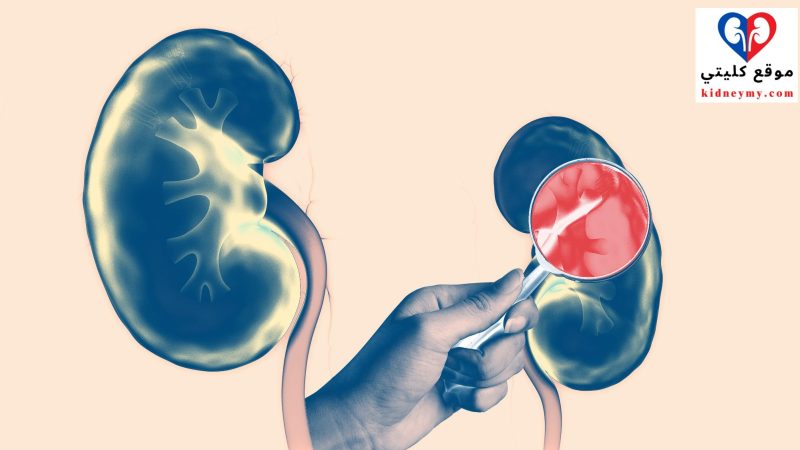 علامات وأعراض أمراض الكلى والفحص المطلوب