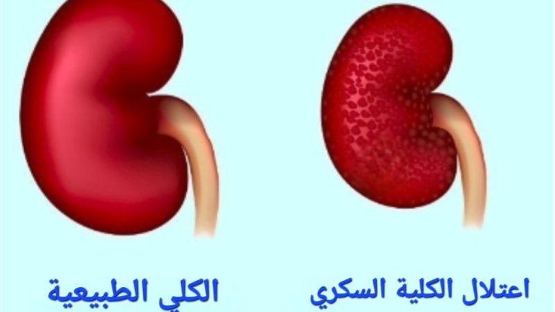 كيف يوثر مرض السكر علي الكلي؟