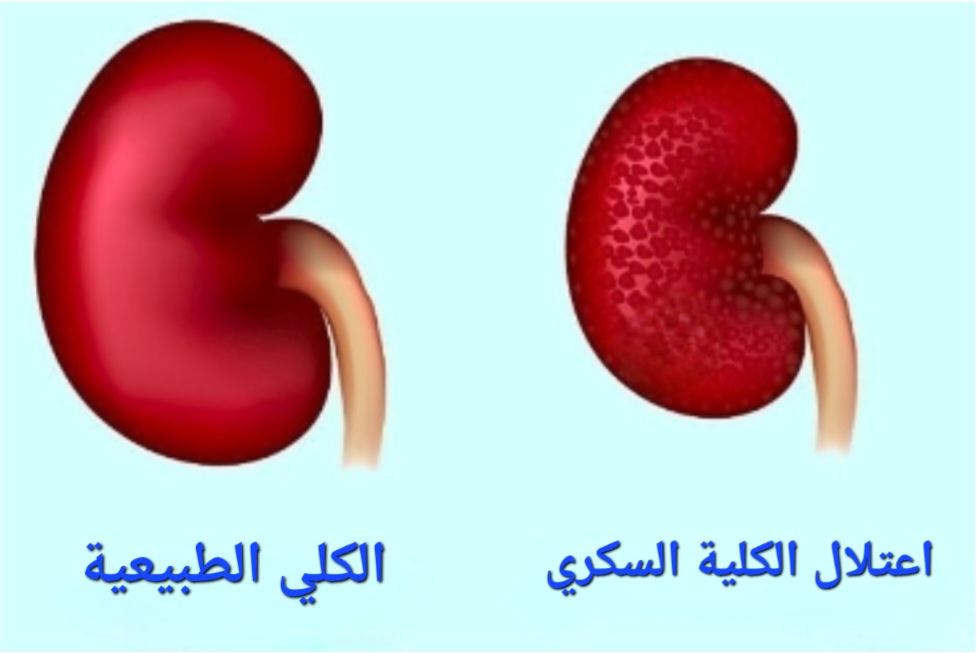 كيف يوثر مرض السكر علي الكلي؟