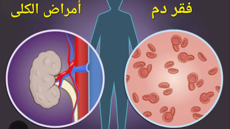 لماذا تسبب أمراض الكلى الأنيميا؟ واسرع طرق العلاج