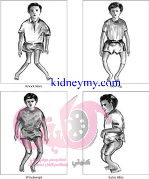 A Guide to Prevent Rickets