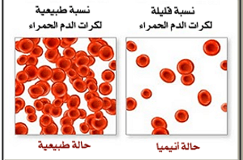 فقر الدم علاج
