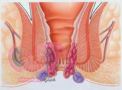 مرض البواسير علاج وانواع ووقاية