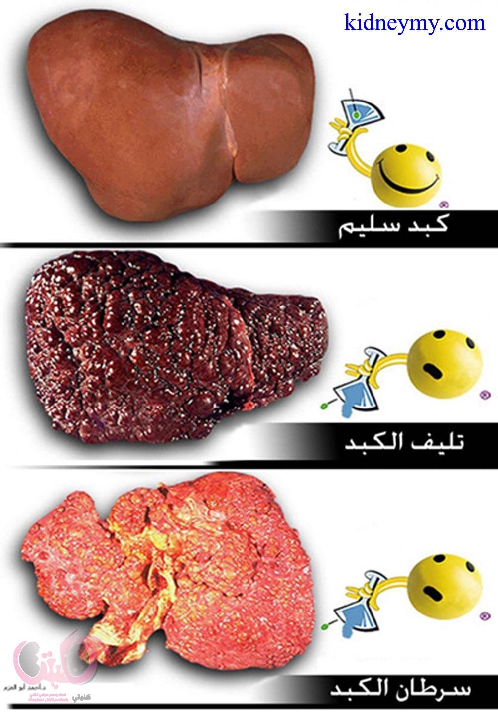 تلف الكبد وماذا يحدث للانسان عند تليف الكبد