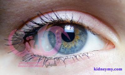 اكثر امراض العيون انتشارا بسبب غسيل الكلي