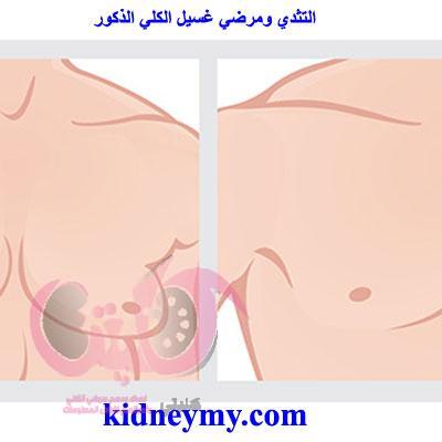 التثدي يصيب 50% من مرضي غسيل الكلي الذكور