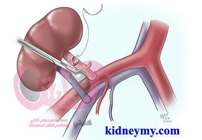 اسباب فشل عملية زراعة الكلي