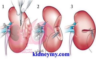 خيارات العلاج الجراحي لسرطان الكلى