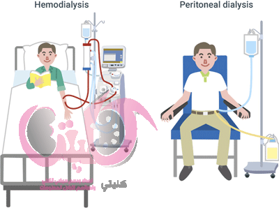 أنواع ماكينات الغسيل الكلوي