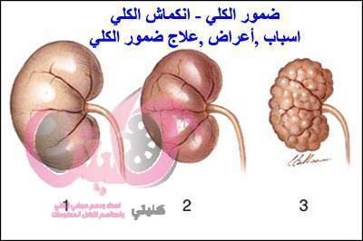 ضمور الكلي اسباب وعلاج انكماش الكلي المؤدي للفشل الكلوي