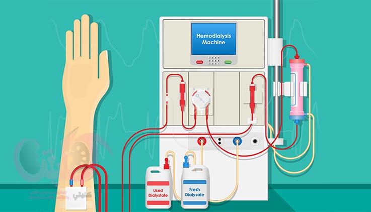 تنقية الدم علاج فشل الكلية في أداء وظيفتها لتخليص الجسم من السموم