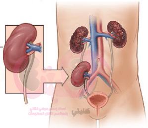 Causes, complications of renal transplantation