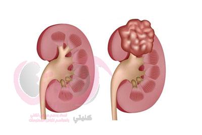 كم يعيش مريض سرطان الكلى؟