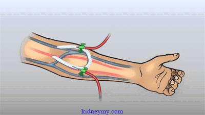 الفرق بين الناسور والجرافت وايهما افضل لمريض الغسيل الكلوي اكثر انواع الوصول للاوعية الدموية
