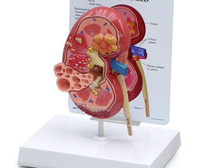 علامات الشفاء من الفشل الكلوي تعتمد على حالة المرض ونوع الفشل الكلوي المصاب به