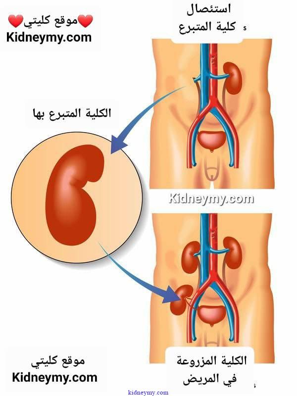 اسرار الحياة بعد زرع كلي ومضاعفات المدي الطويل والقصير وأسئلة شائعة