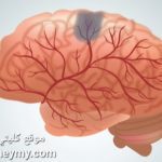 مرض الأوعية الدموية الدماغية من اسباب الهلوسة بعد غسيل الكلى 