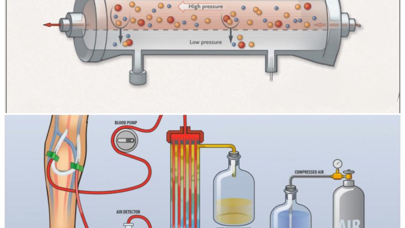 ما هو الفرق بين غسيل الكلى وترشيح الدم HD/HDF