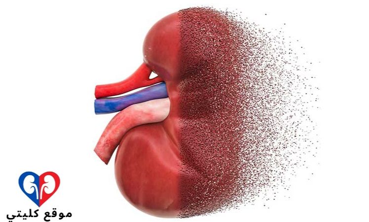 الأسباب الرئيسية وراء فشل عملية زراعة الكلي التي يجب مراعاتها