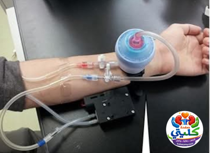 غسيل كلى محمول للطواريء | ابتكار ياباني قد يغير علاج الفشل الكلوي