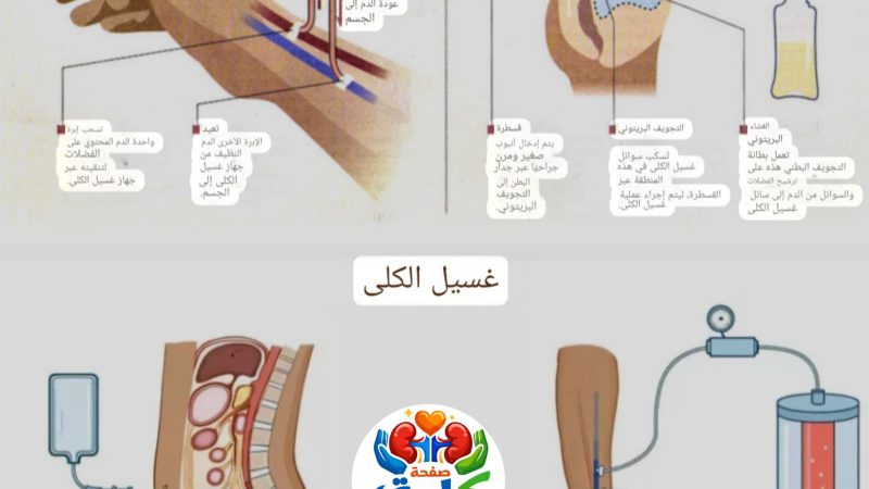 ترتيب أنواع الغسيل الكلوي حسب الكفاءة العلاجية علي المرضي