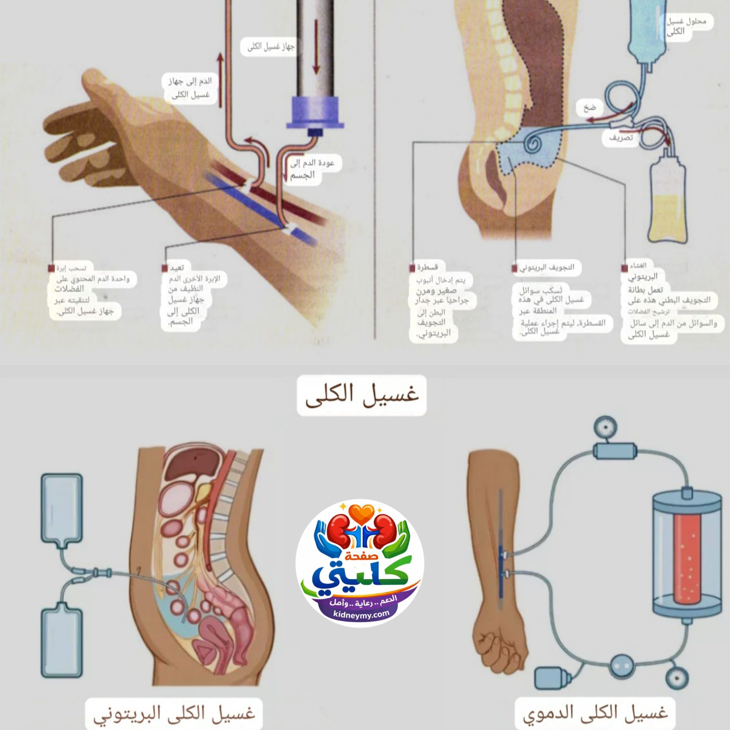 ترتيب أنواع الغسيل الكلوي حسب الكفاءة العلاجية علي المرضي